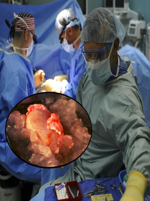 Pig kidney transplant done by US surgeons saved Rick Slaymans life